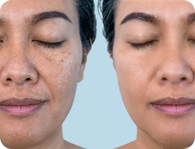 Hudly-Hudpigmentering-Vad_behandlingen_kan_gora_